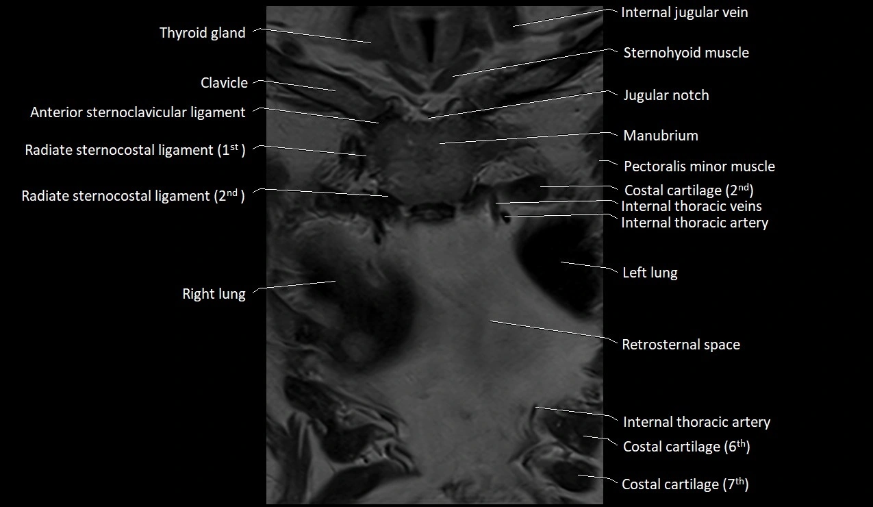 MRI sternum and sternoclavicular joint labeled coronal anatomy image 11.webp